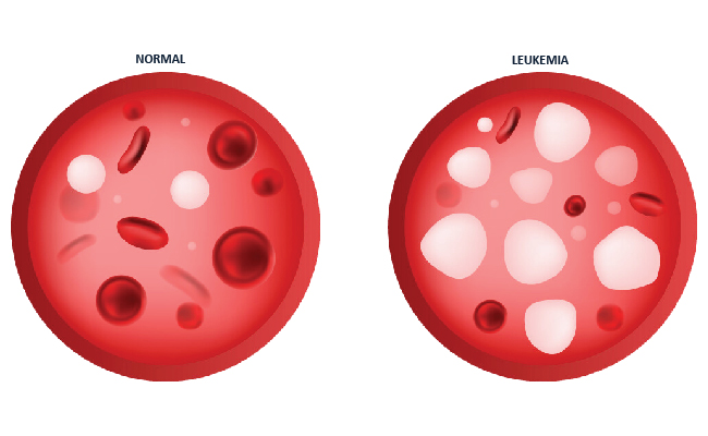 normal vs luekeima cancer cell