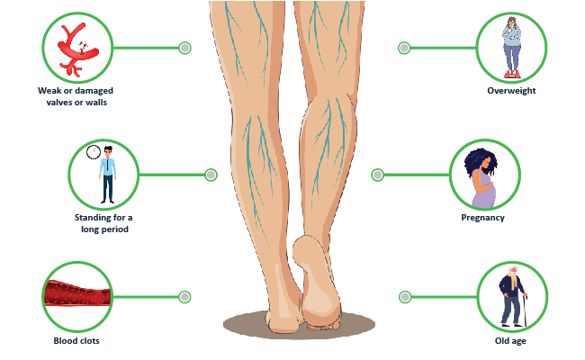 Causes-of-varicose-veins