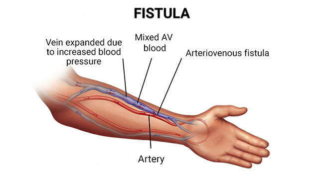 fistula treatment in veins