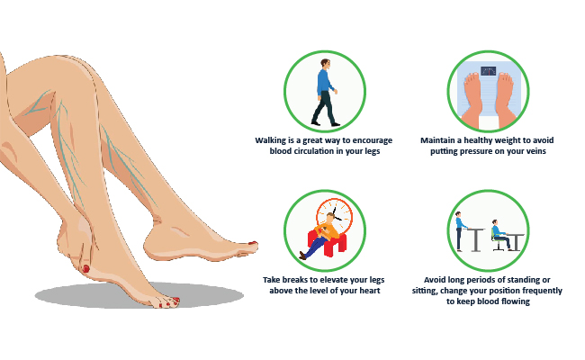 How-to-prevent-varicose-veins