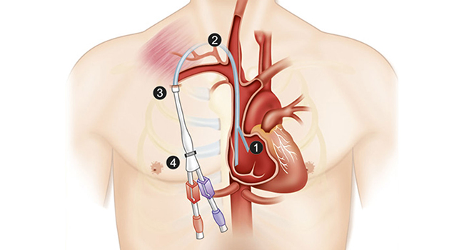 Perm catheter dialysis process