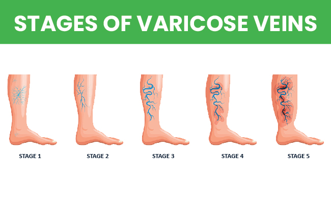 Stages-of-varicose-veins