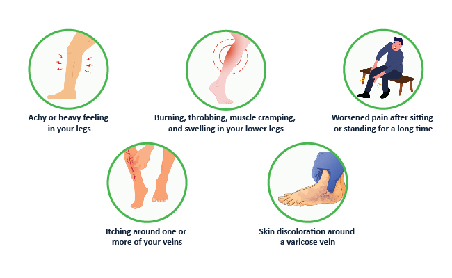 Symptoms-of-varicose-veins