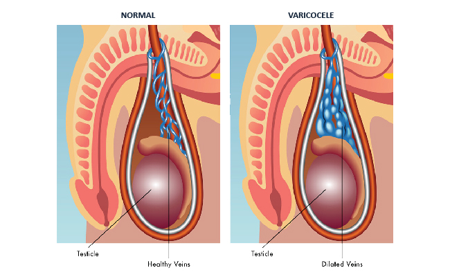 Normal VS Varicocele Image