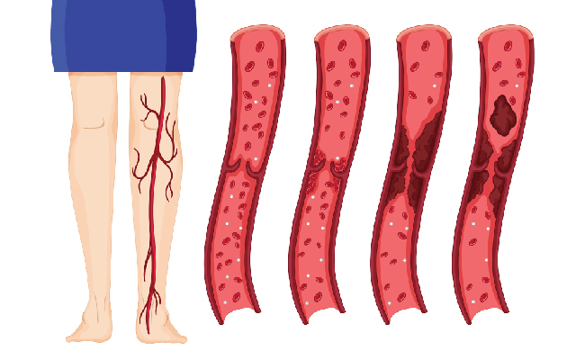 deep vein thrombosis disease process