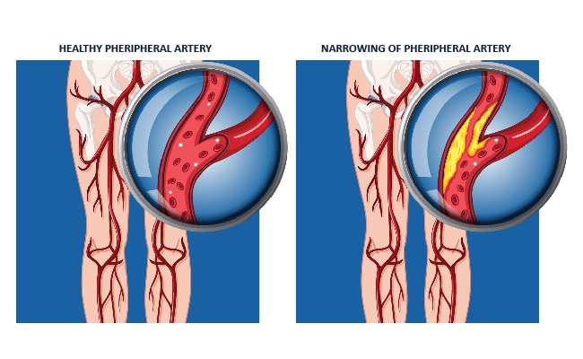healthy vs normal PAD